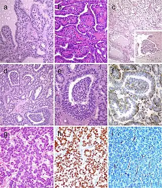 Hyperfunctioning follicular adenoma typically shows follicles with papillary infoldings and bubbly, pale colloid with peripheral scalloping (a). Non-hyperfunctioning adenomas with papillary hyperplasia usually show a more predominantly papillary pattern without vacuolated cytoplasm and scalloping colloid (b). Rare hyperfunctioning follicular tumors (c) can show capsular and/or venous invasion (inset); the nuclei are very clear which may be associated to hyperfunctioning. The glomeruloid pattern in this follicular thyroid carcinoma (FTC) included follicles with round to oval tufts growing within, at times supported by a fibrovascular core mimicking the renal glomerulus (d and e); empty follicles were lined by columnar cells with marked pseudostratification, and positivity for CK18 was detected (f). FTC (g) with TTF1 expression (h) and very focal expression of thyroglobulin i[9]